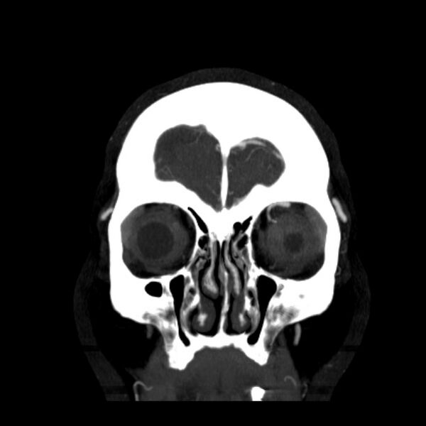 File:Cerebral arteriovenous malformation (Radiopaedia 43729-47189 C 4).jpg