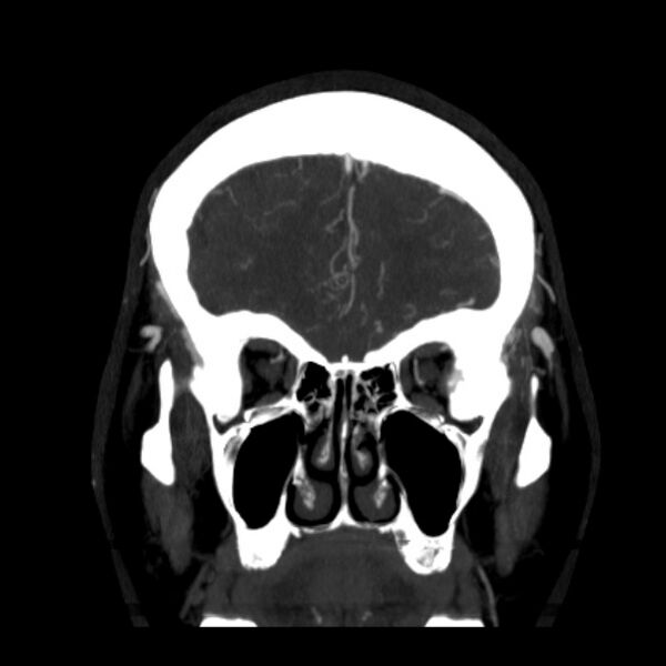 File:Cerebral arteriovenous malformation (Radiopaedia 43729-47189 C 9).jpg