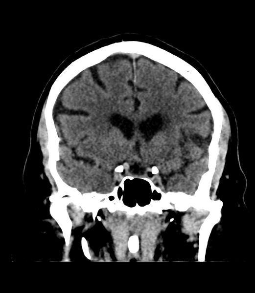 File:Cerebral dural venous sinus thrombosis (Radiopaedia 86514-102575 Coronal non-contrast 17).jpg