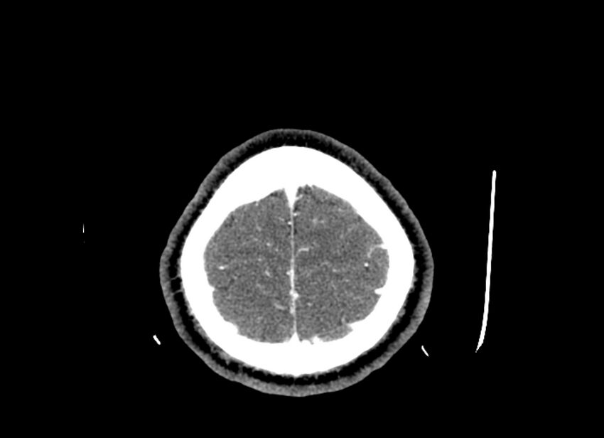 Cerebral edema (Radiopaedia 82519-96661 B 10).jpg