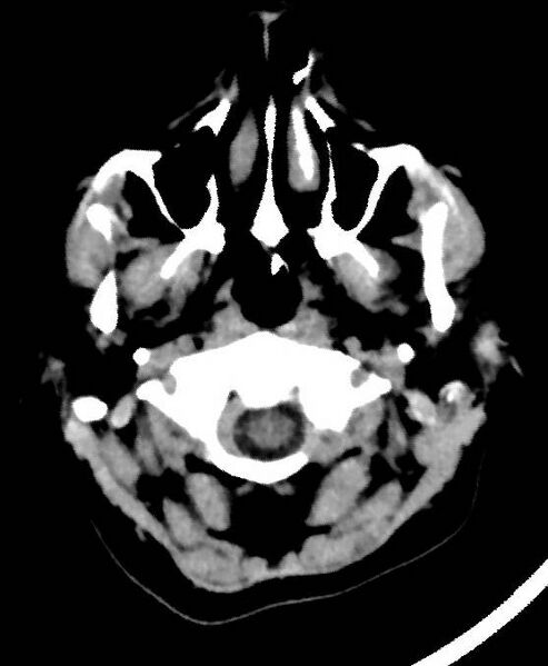 File:Cerebral edema due to severe hyponatremia (Radiopaedia 89826-106937 Axial non-contrast 2).jpg