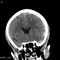 Cerebral hemorrhagic contusion with subdural and subarachnoid hemorrhage (Radiopaedia 10680-11146 Coronal non-contrast 7).jpg