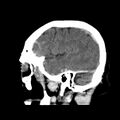 Cerebral hemorrhagic contusions (Radiopaedia 23145-23188 C 10).jpg