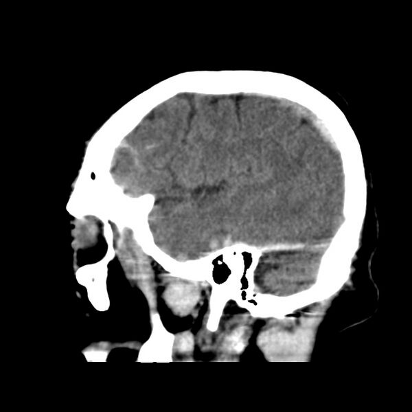 File:Cerebral hemorrhagic contusions (Radiopaedia 23145-23188 C 10).jpg