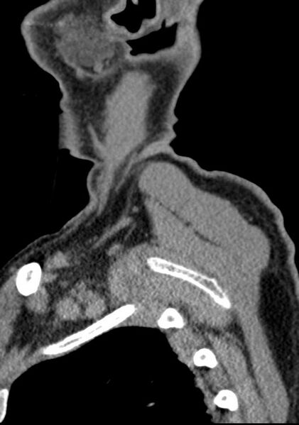 File:Cerebral hemorrhagic contusions and cervical spine fractures (Radiopaedia 32865-33841 G 9).jpg