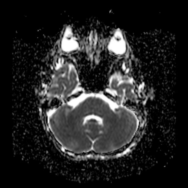 File:Cerebral tuberculoma (Radiopaedia 41152-43932 Axial ADC 5).jpg