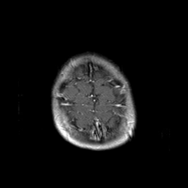 File:Cerebral tuberculoma (Radiopaedia 41152-43932 Axial T1 C+ 21).jpg
