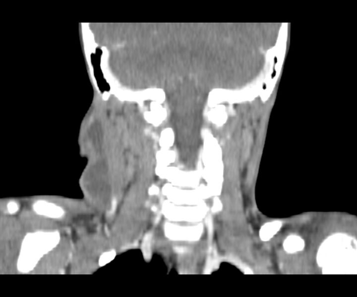 File:Cervical cystic lymphangioma (Radiopaedia 63655-72332 Coronal + contrast 25).jpg