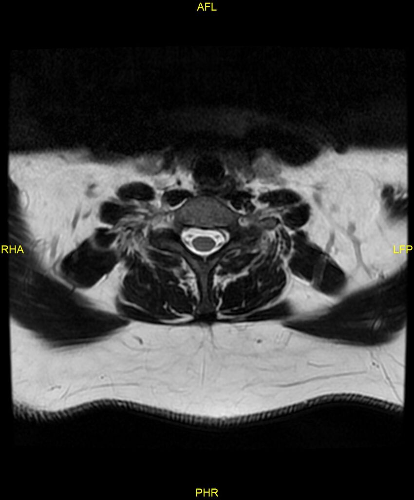 Cervical disc protrusion (Radiopaedia 87147-103415 Axial T2 59).jpg