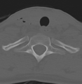 Cervical disc replacement (Radiopaedia 37383-39205 Axial bone window 18).png