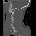 Cervical flexion teardrop fracture with cord hemorrhage (Radiopaedia 32497-33454 Sagittal bone window 14).jpg