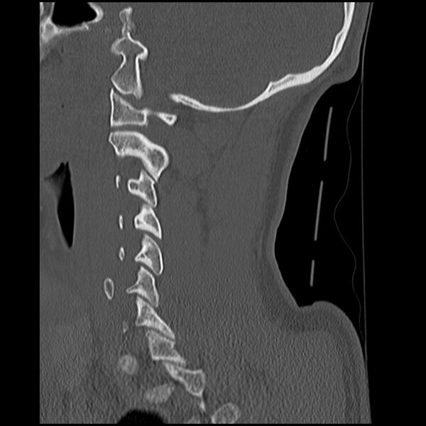 File:Cervical flexion teardrop fracture with cord hemorrhage (Radiopaedia 32497-33454 Sagittal bone window 14).jpg