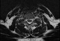 Cervical schwannoma (Radiopaedia 72399-82934 Axial T2 17).jpg