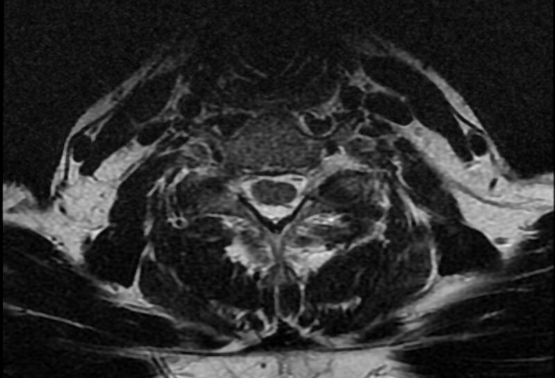 File:Cervical schwannoma (Radiopaedia 72399-82934 Axial T2 17).jpg