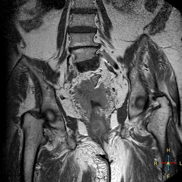 File:Cervical stump squamous cell carcinoma (Radiopaedia 48049-52858 Coronal T1 C+ 10).jpg
