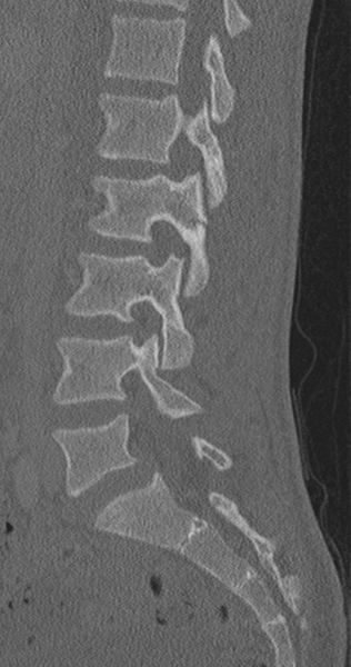 File:Chance fracture (Radiopaedia 40360-42912 Sagittal bone window 58).png