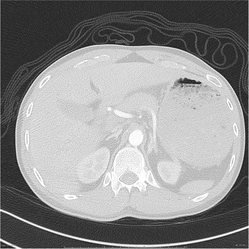 Chest and abdomen multi-trauma (Radiopaedia 26294-26425 lung window 105).jpg