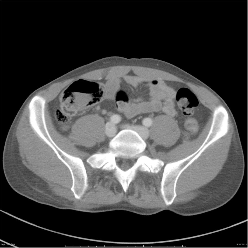 Chest and abdomen multi-trauma (Radiopaedia 26294-26426 A 62).jpg