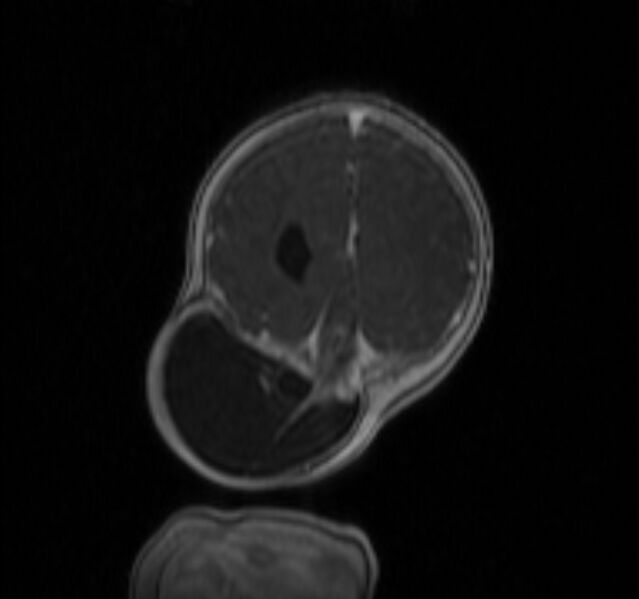 File:Chiari III malformation with occipital encephalocele (Radiopaedia 79446-92559 Coronal T1 C+ mpr 43).jpg