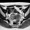 Chocolate cysts (endometriomata) (Radiopaedia 25072-25329 Axial T2 1).jpg
