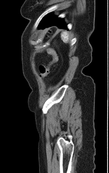 File:Cholecystoduodenal fistula due to calculous cholecystitis with gallstone migration (Radiopaedia 86875-103077 C 5).jpg