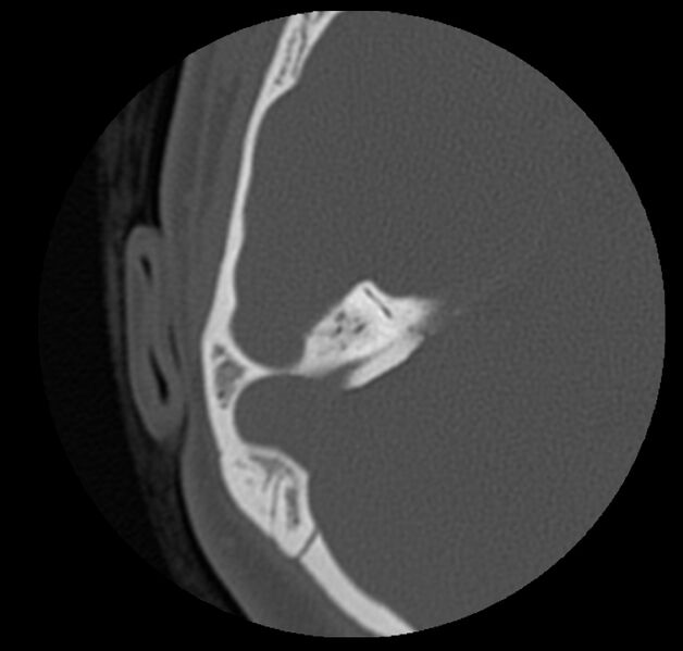 File:Cholesteatoma (Radiopaedia 20296-20217 bone window 36).jpg