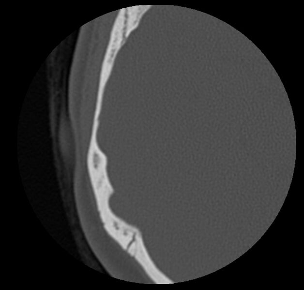 File:Cholesteatoma (Radiopaedia 20296-20217 bone window 44).jpg