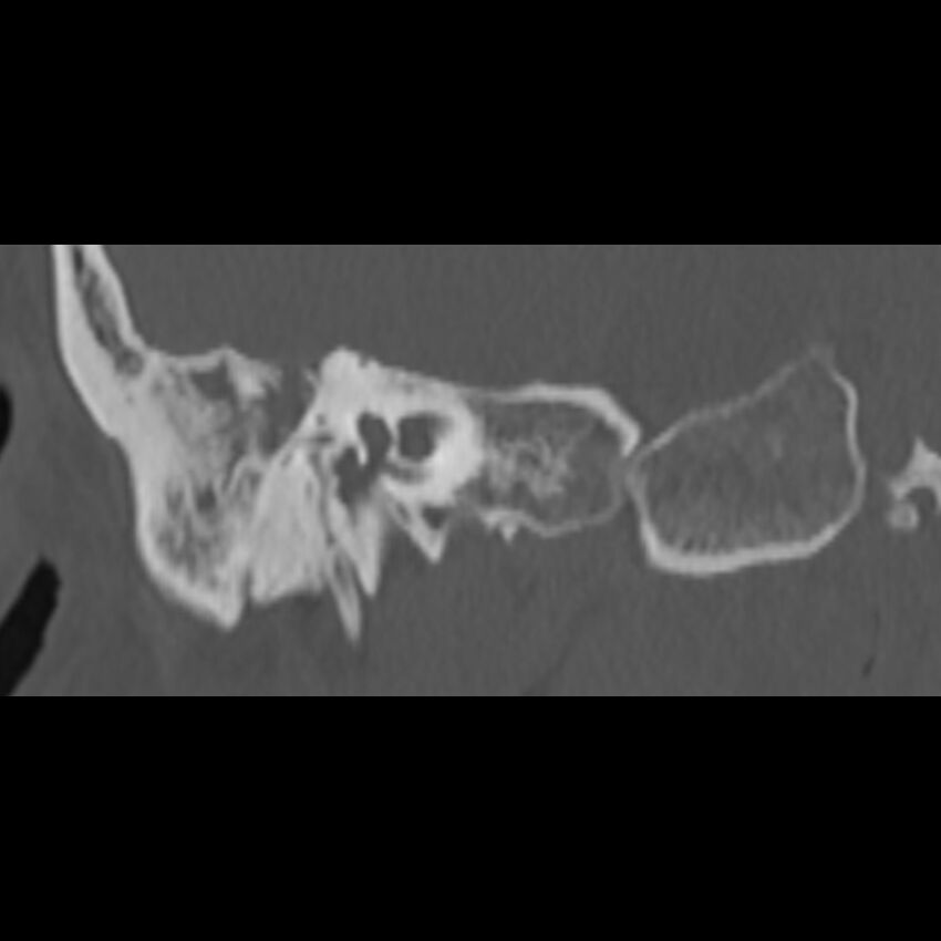 Cholesteatoma (Radiopaedia 68176-77673 Coronal bone window 43).jpg