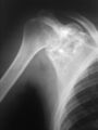 2. X-ray of chondroblastoma of shoulder blade