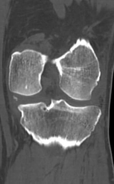 File:Chondrocalcinosis (Radiopaedia 82862-97173 Coronal bone window 52).jpg