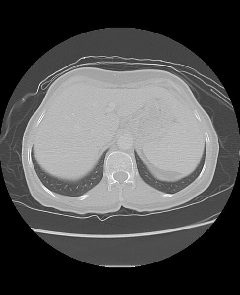 File:Chondrosarcoma (Radiopaedia 79427-92532 Axial lung window 52).jpg