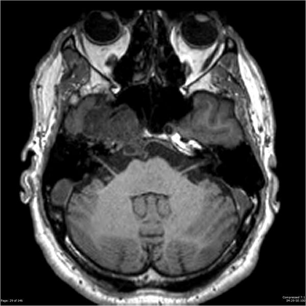 File:Chondrosarcoma of skull base- grade II (Radiopaedia 40948-43654 Axial T1 29).jpg