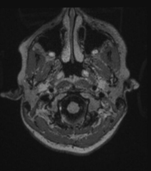 File:Choroid plexus carcinoma (Radiopaedia 91013-108553 Axial FLAIR C+ 74).jpg