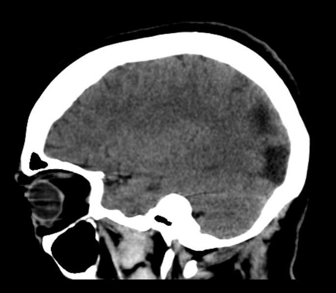 File:Chronic bilateral occipital lobe infarcts (Radiopaedia 31276-31996 C 13).jpg