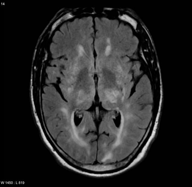File:Chronic hypertensive encephalopathy (Radiopaedia 4564-6686 Axial FLAIR 7).jpg