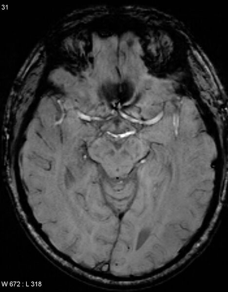 File:Chronic lymphocytic inflammation with pontine perivascular enhancement responsive to steroids (CLIPPERS) (Radiopaedia 37520-39374 Axial SWI 30).jpg