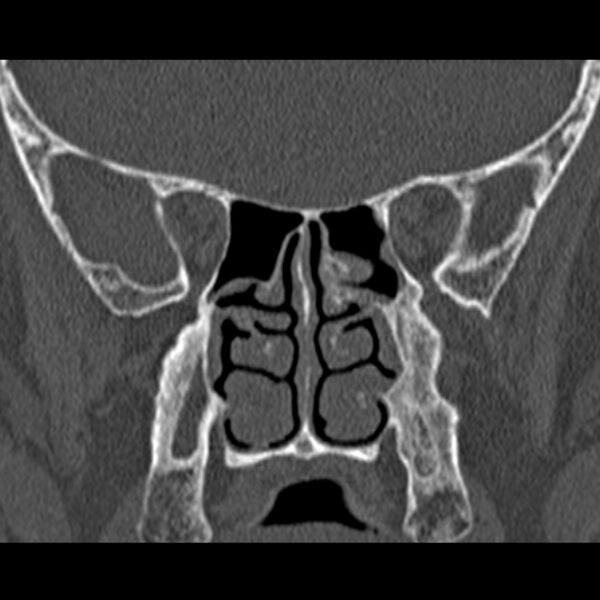 File:Chronic maxillary sinusitis (Radiopaedia 27879-28116 Coronal bone window 35).jpg