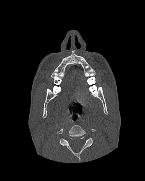 File:Chronic maxillary sinusitis caused by a foreign body (Radiopaedia 58521-65676 Axial bone window 28).jpg