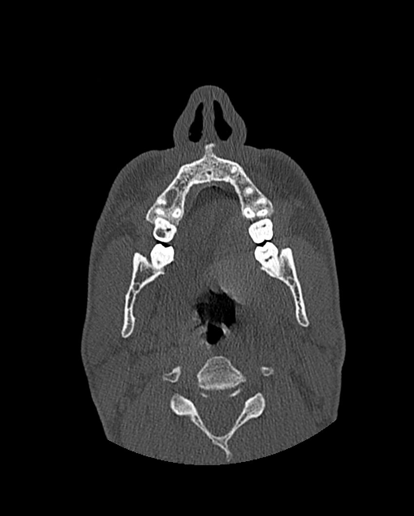 Chronic maxillary sinusitis caused by a foreign body (Radiopaedia 58521-65676 Axial bone window 28).jpg