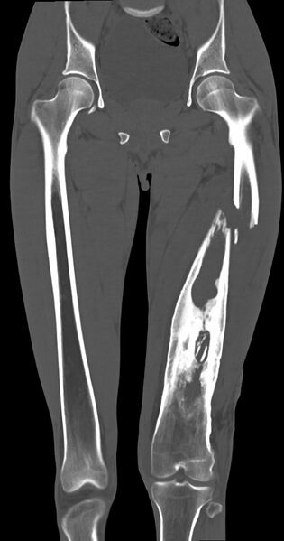 File:Chronic osteomyelitis (with sequestrum) (Radiopaedia 74813-85822 Coronal non-contrast 26).jpg