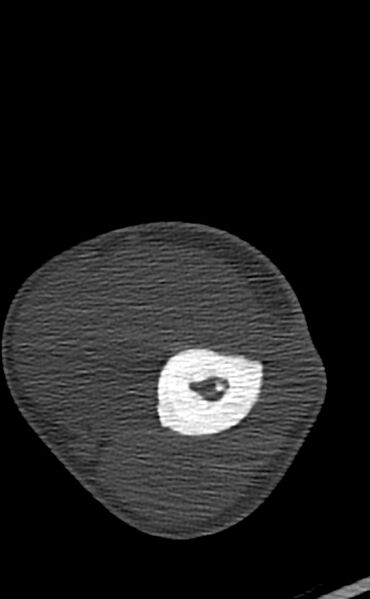 File:Chronic osteomyelitis of the distal humerus (Radiopaedia 78351-90971 Axial bone window 63).jpg