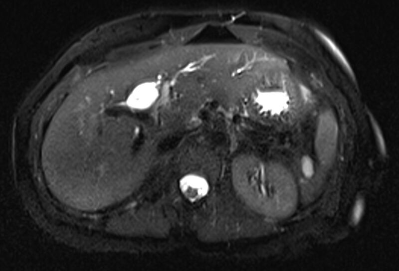 File:Chronic pancreatitis - pancreatic duct calculi (Radiopaedia 71818-82250 Axial T2 fat sat 20).jpg