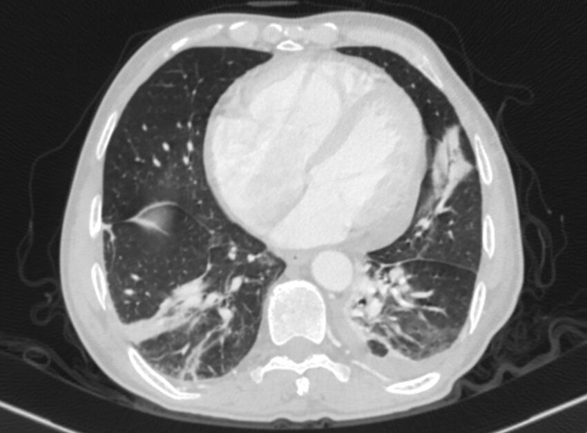 Chronic pulmonary embolism with bubbly consolidation (Radiopaedia 91248-108850 Axial lung window 111).jpg