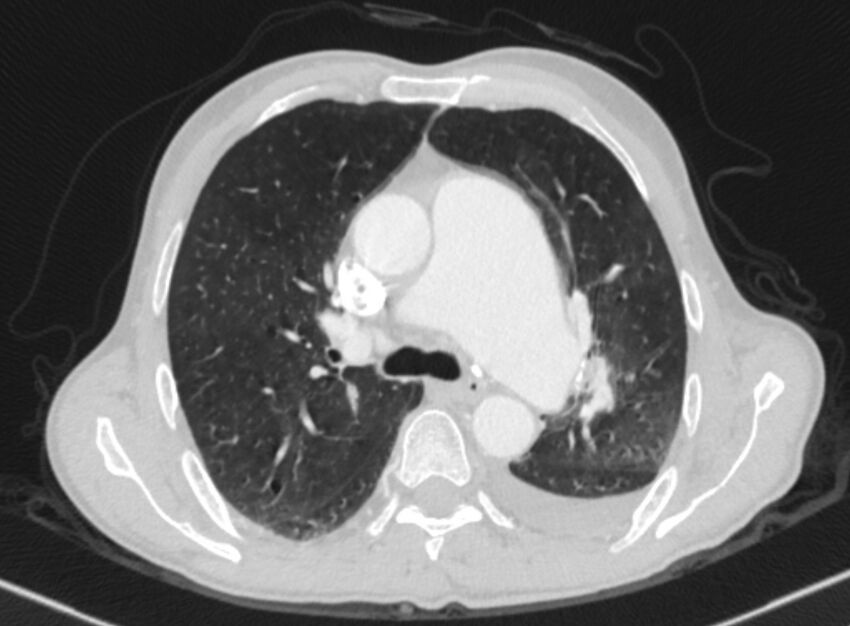 Chronic pulmonary embolism with bubbly consolidation (Radiopaedia 91248-108850 Axial lung window 64).jpg