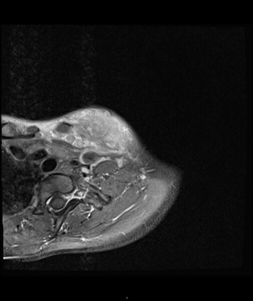 File:Chronic reactive multifocal osteomyelitis (CRMO) - clavicle (Radiopaedia 56406-63071 Axial T1 C+ fat sat 5).jpg