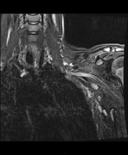 File:Chronic reactive multifocal osteomyelitis (CRMO) - clavicle (Radiopaedia 56406-63114 Coronal STIR 9).jpg