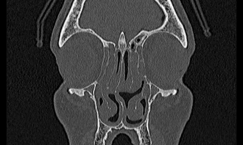 File:Chronic rhinosinusitis (Radiopaedia 65079-74075 Coronal bone window 20).jpg