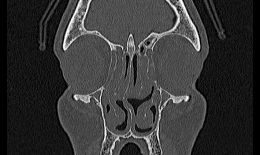 Chronic rhinosinusitis (Radiopaedia 65079-74075 Coronal bone window 20).jpg