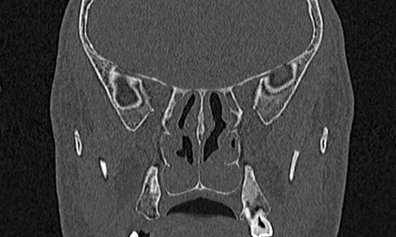 File:Chronic rhinosinusitis (Radiopaedia 65079-74075 Coronal bone window 57).jpg