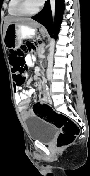 File:Chronic small bowel volvulus (Radiopaedia 75224-86322 C 69).jpg